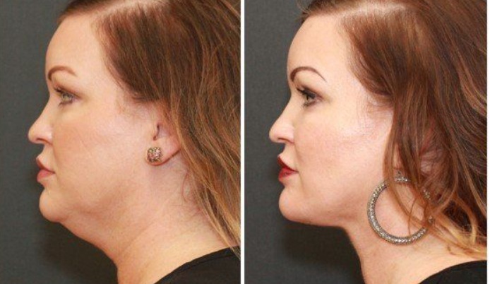 Can You Have a Neck Lift Without Surgery?